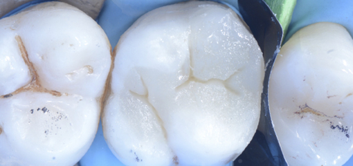 Клинический случай прямой композитной реставрации жевательных зубов