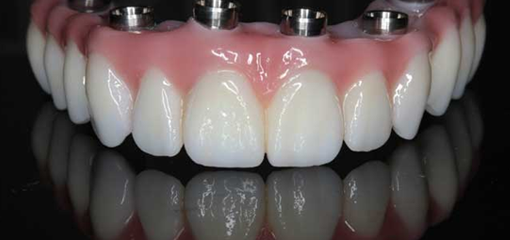 Полное восстановление зубных рядов с помощью несъёмных протезов, фиксированных на имплантатах