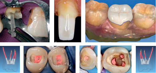 Доказательное планирование реставрации эндодонтически леченных одиночных зубов: значение герметичности коронки, наличия и отсутствия штифта, прямой и непрямой реставрации