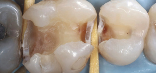 Прямая композитная реставрация жевательной группы зубов: метод StyleItaliano