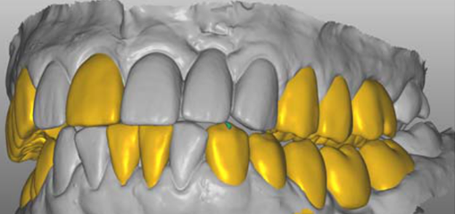 Виртуальный wax-up с принципами последовательной дезокклюзии зубов