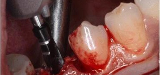 Влияние применения плазмы, обогащенной фибрином, и техники расщепления лоскута на утолщение профиля мягких тканей и потерю кости вокруг дентальных имплантатов