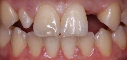 Цифровой протокол восстановления отсутствующего 22 зуба и шиповидного 12