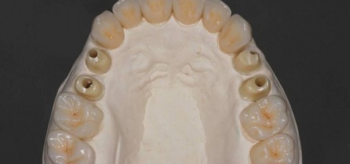 Комплексная тотальная реабилитация зубных рядов