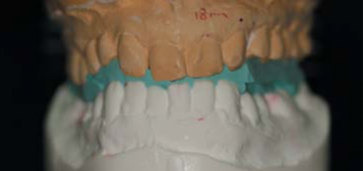 Использование принципов нейро-мышечной стоматологии при реконструктивном протезировании пациента с патологией прикуса и дисфункцией ВНЧС