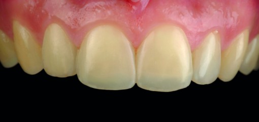 Полная реабилитация зубных рядов с применением композитного материала в комбинации с технологией термоформования