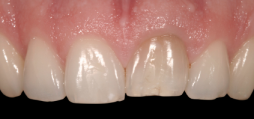 Анкилоз. Часть 2 (из 5): Лечение взрослых с анкилозом зуба