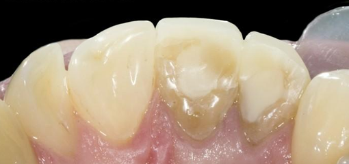 Маскировка выраженного изменения цвета передних зубов