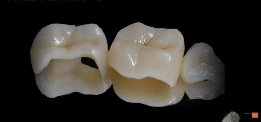 Повторная реставрация боковых зубов по CAD/CAM технологии