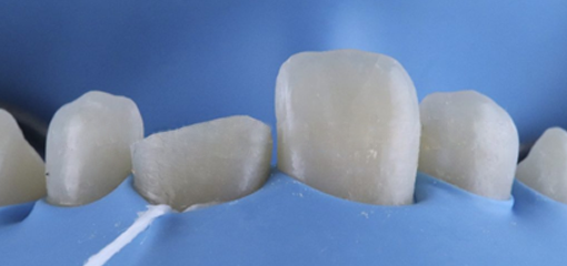 Реставрация эндодонтически леченного зуба