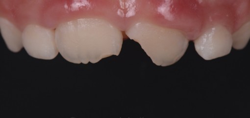 Реставрации фронтальных зубов: от «фастфуда» до «премиум» класса. Показания к различным уровням сложности