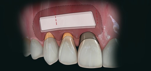Модифицированная туннельная техника с применением двухслойного ADM при работе в области зубов и имплантатов: наблюдение 3,5 года