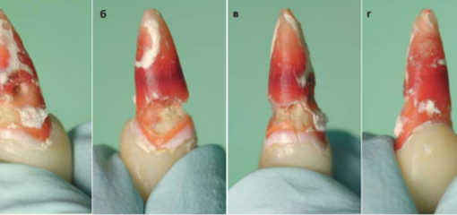 Резорбция корня при отбеливании девитальных зубов, или как можно испортить хорошее «эндо»