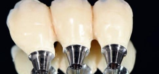 Временные CAD/CAM реставрации и цифровой подход к стоматологической реабилитации