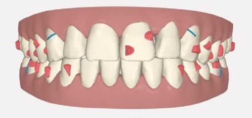 Лечение дистального соотношения рядов с помощью системы ортодонтических элайнеров INVISALIGN
