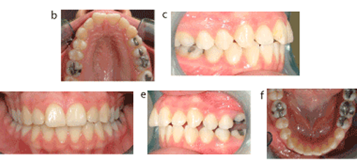 Анкилозирование постоянных зубов: частота возникновения, этиология и руководство по клиническому ведению