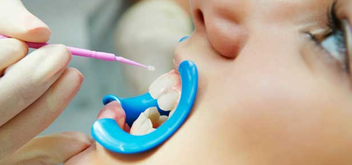 Сравнительная характеристика препаратов для глубокого фторирования эмали зубов