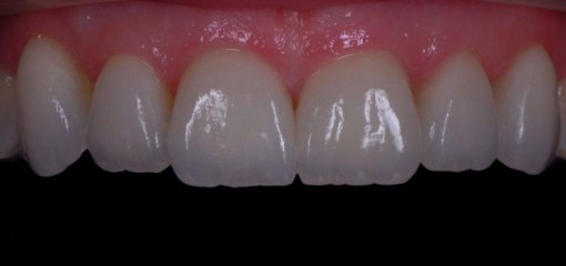 Правила ухода за зубами после художественной реставрации