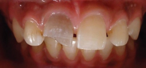 Клинический случай ревитализации зуба с использованием обогащенной фибрином плазмы