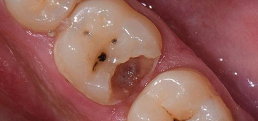 Лечение глубокого кариеса боковых зубов, пошаговый протокол