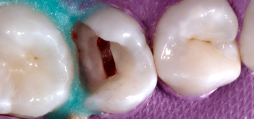 Пульпотомия в постоянном сформированном зубе. Часть 1