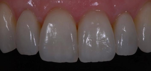 Керамические виниры с покрытием корня зуба