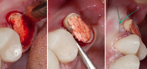 Хирургическая экструзия зуба. Нужно ли всегда удалять зуб без феррула?