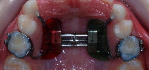 Скученность верхних латеральных резцов: простая процедура, не затрагивающая постоянные зубы