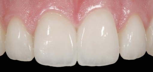 Восстановление утраченных тканей в стоматологии