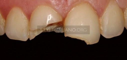 Реставрация тяжелого перелома зуба: клинический случай с 13-летним наблюдением