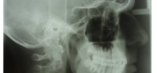 Биомеханика форсированного ортодонтического лечения скученного положения зубов передней группы при сужении зубных рядов