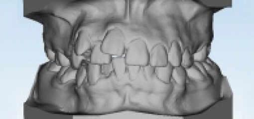 Ортодонтическое лечение анкилозированного верхнего резца методом дистракционного остеогенеза в сочетании с простой ортодонтической биомеханикой