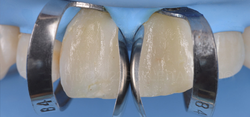 Техника «крыла» для фронтальных зубов. Реалистичный подход