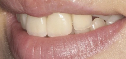 Отбеливание девитализированных зубов