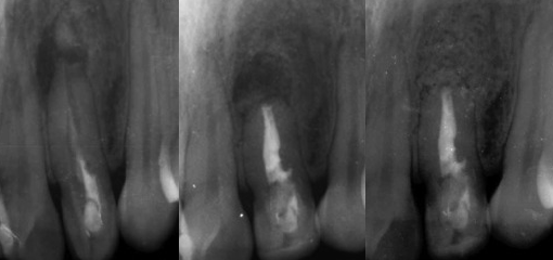Повторное эндодонтическое лечение и восстановление «зуба в зубе» типа 2 с помощью новых технологий