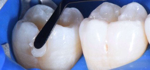 Реставрации боковой группы зубов. Какую консистенцию выбрать?