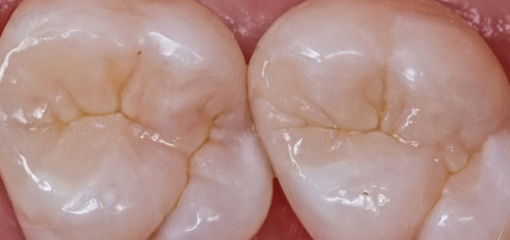 Реставрация жевательных зубов. Структура оттенков