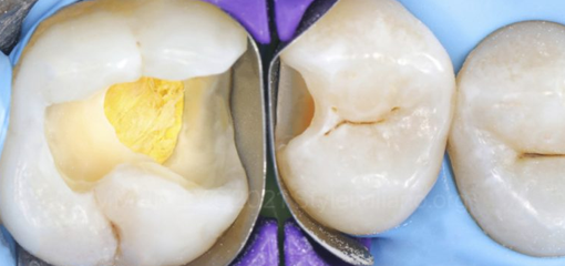 Восстановление естественной анатомии зуба: прямая композитная реставрация II класса