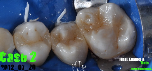 Прямая реставрация боковых зубов. Случай №2
