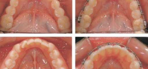 Сравнение самолигирующих и традиционных лигатурных брекетов в лечении скученности зубов нижней челюсти: клиническая оценка продолжительности лечения и достигнутых результатов