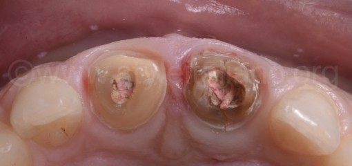 Модифицированная техника цифрового литья для управления мягкими тканями. Установка имплантата после удаления зуба.
