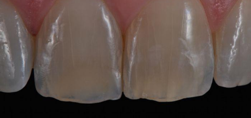 Простой протокол восстановления фронтальной группы зубов