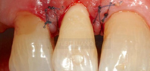 Горизонтальный перелом зуба, протокол лечения