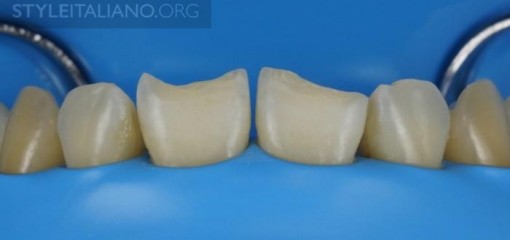 Пошаговый протокол реставрации передних зубов IV класса