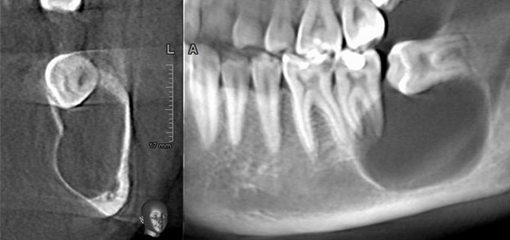 3D диагностика и принципы визуализации 3-х моляров нижней челюсти