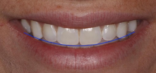 Определение позиции режущего края верхних зубов при помощи дентальной фотографии