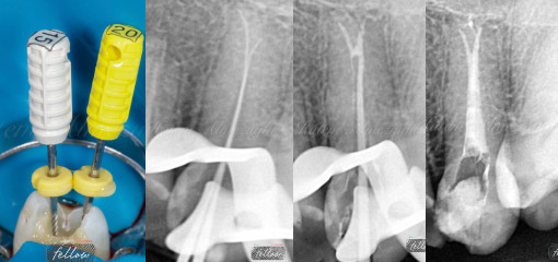 Лечение зубов с глубоким разветвлением каналов в апикальной трети
