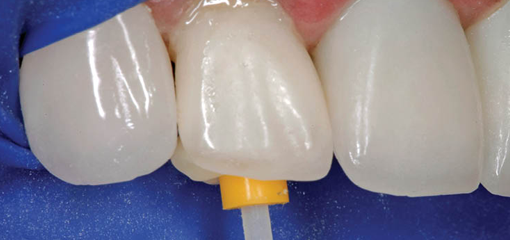 Экстренное восстановление фронтального зуба после неудачного лечения