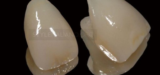 Композитные накладки на передние зубы (клинический случай с 10-летним наблюдением)