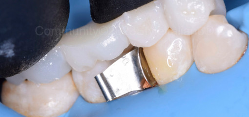 Минимизируем окклюзионные коррекции при реставрации жевательной группы зубов